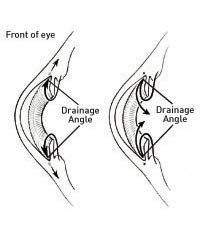 Glaucoma