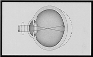 Hyperopia Correction