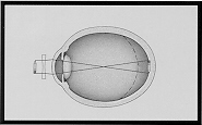 Myopia Correction
